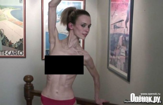 Анорексичная голая девушка. (7 фото)